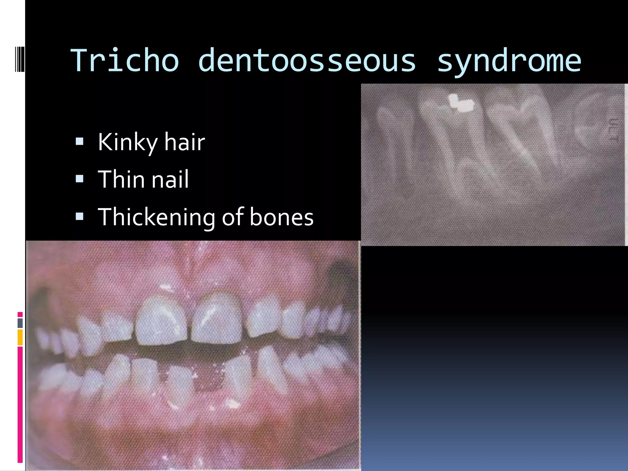 Tricho dentoosseous syndrome
 Kinky hair
 Thin nail
 Thickening of bones
 