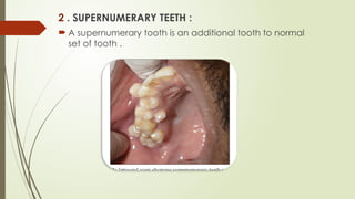 DEVELOPMENTAL DISTURBANCES OF TEETH [Autosaved].pptx