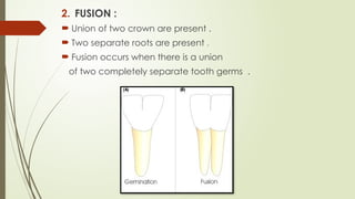 DEVELOPMENTAL DISTURBANCES OF TEETH [Autosaved].pptx