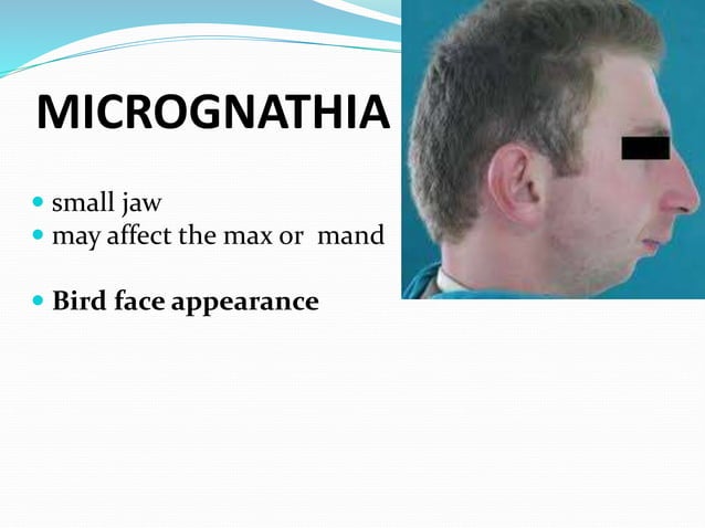 Developmental disturbances of the jaws | PPTX | Dental Health ...