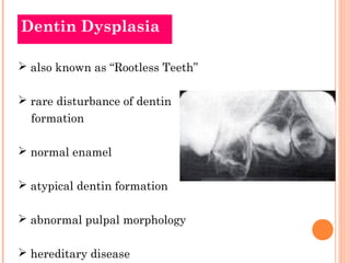 Dentin Dysplasia

 also known as “Rootless Teeth”

 rare disturbance of dentin
  formation

 normal enamel

 atypical ...