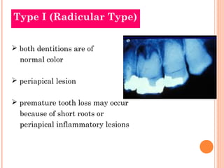 Type I (Radicular Type)


 both dentitions are of
  normal color

 periapical lesion

 premature tooth loss may occur
 ...