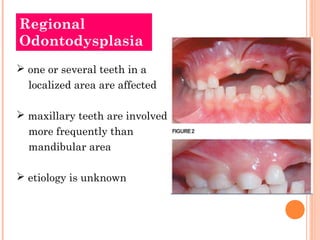 Regional
Odontodysplasia
 one or several teeth in a
  localized area are affected

 maxillary teeth are involved
  more ...