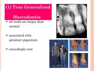 (1) True Generalized

     Macrodontia
 all teeth are larger than
  normal

 associated with
  pituitary gigantism

 ex...