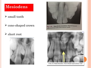 Mesiodens

 small tooth

 cone-shaped crown

 short root
 