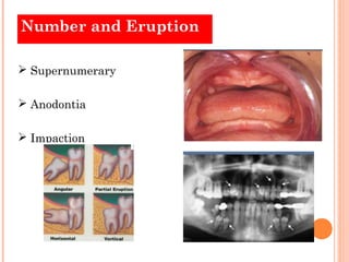 Number and Eruption

 Supernumerary

 Anodontia

 Impaction
 