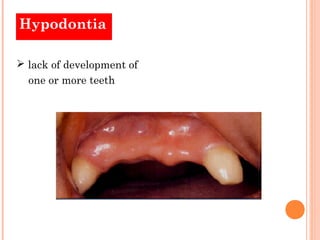 Hypodontia

 lack of development of
  one or more teeth
 