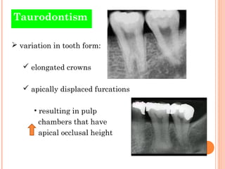 Taurodontism

 variation in tooth form:

    elongated crowns

    apically displaced furcations

      • resulting in ...