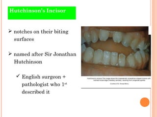 Hutchinson’s Incisor


 notches on their biting
  surfaces

 named after Sir Jonathan
  Hutchinson

    English surgeon...