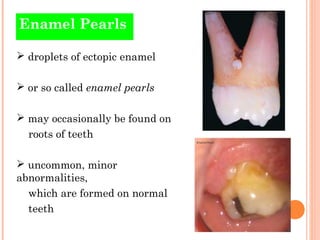 Enamel Pearls

 droplets of ectopic enamel

 or so called enamel pearls

 may occasionally be found on
  roots of teeth...