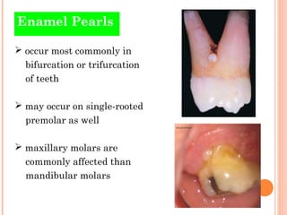 Enamel Pearls

 occur most commonly in
  bifurcation or trifurcation
  of teeth

 may occur on single-rooted
  premolar ...