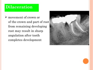 Dilaceration

 movement of crown or
  of the crown and part of root
  from remaining developing
  root may result in shar...