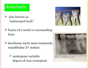 Ankylosis

 also known as
  “submerged teeth”

 fusion of a tooth to surrounding
  bone

 deciduous teeth most commonly...