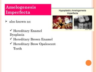 Amelogenesis
Imperfecta

 also known as:

   Hereditary Enamel
  Dysplasia
   Hereditary Brown Enamel
   Hereditary Br...