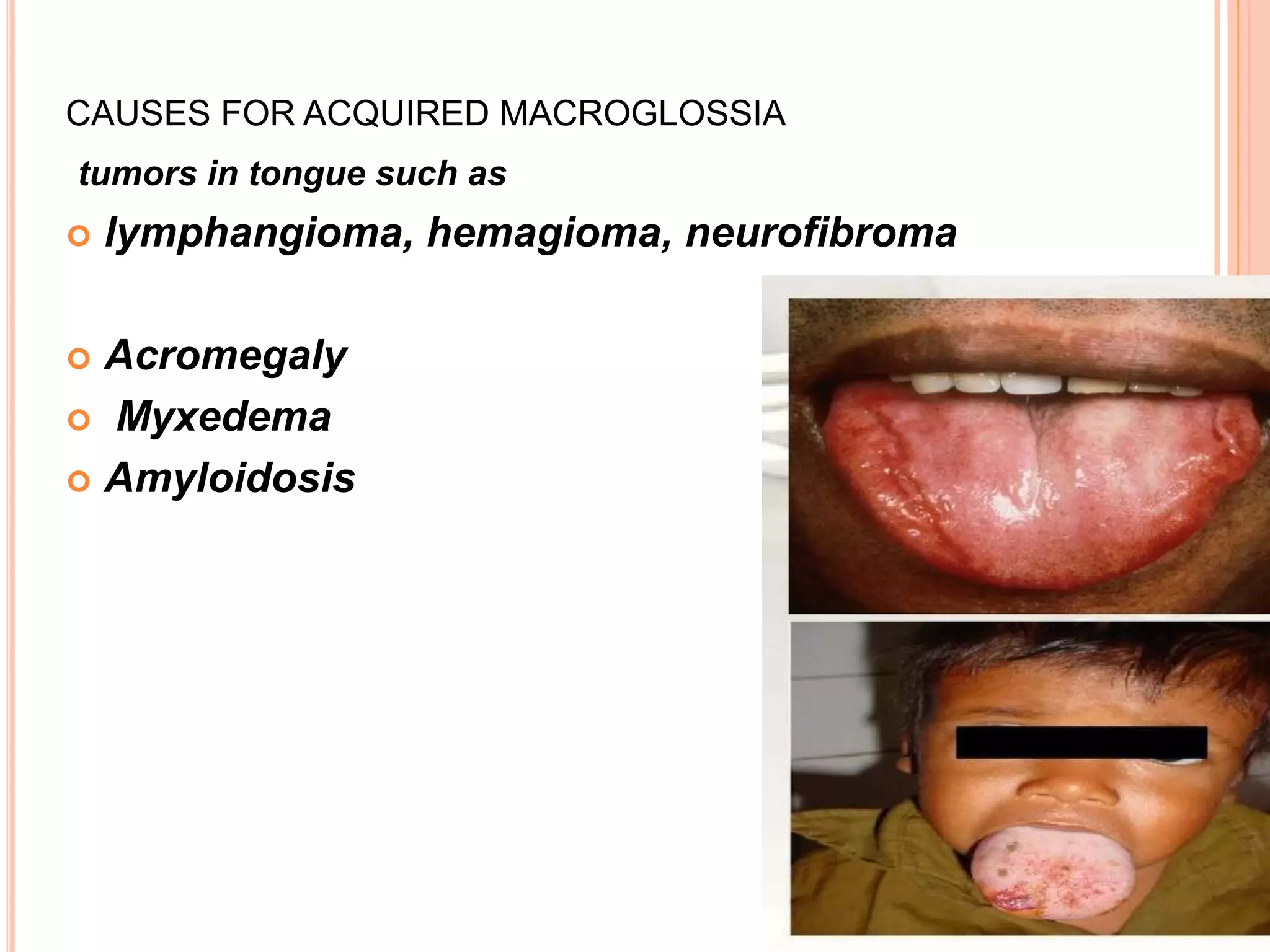 CAUSES FOR ACQUIRED MACROGLOSSIA
tumors in tongue such as
 lymphangioma, hemagioma, neurofibroma
 Acromegaly
 Myxedema
 Amyloidosis
 