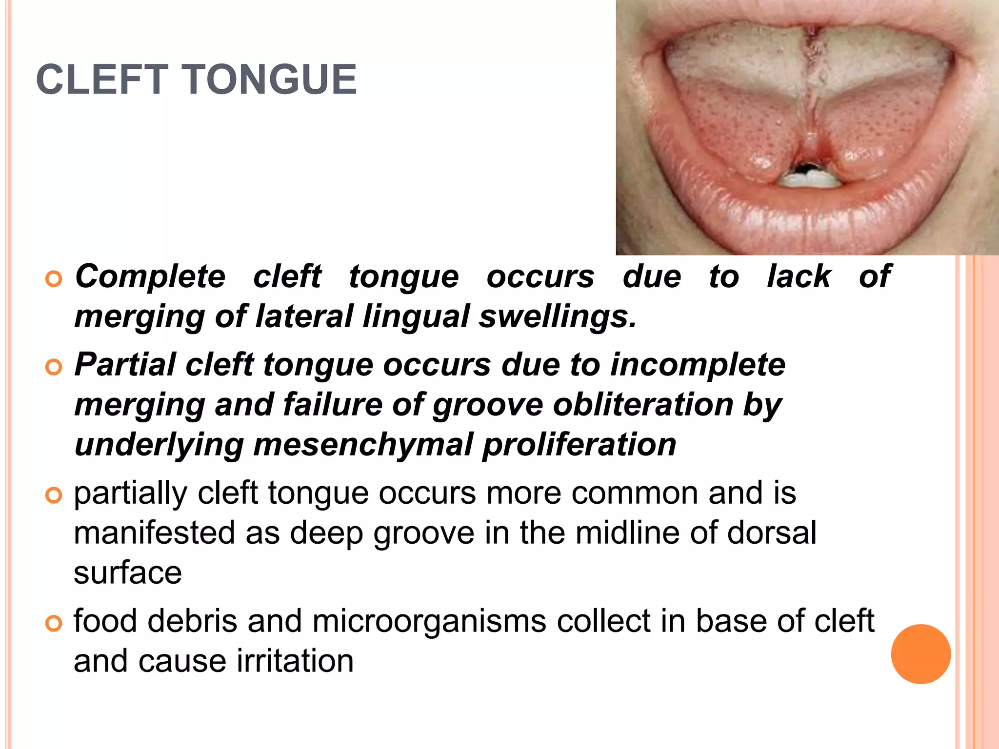 CLEFT TONGUE
 Complete cleft tongue occurs due to lack of
merging of lateral lingual swellings.
 Partial cleft tongue occurs due to incomplete
merging and failure of groove obliteration by
underlying mesenchymal proliferation
 partially cleft tongue occurs more common and is
manifested as deep groove in the midline of dorsal
surface
 food debris and microorganisms collect in base of cleft
and cause irritation
 