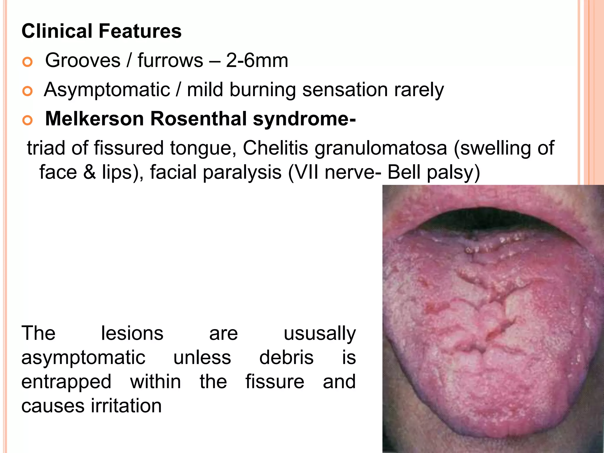 Clinical Features
 Grooves / furrows – 2-6mm
 Asymptomatic / mild burning sensation rarely
 Melkerson Rosenthal syndrome-
triad of fissured tongue, Chelitis granulomatosa (swelling of
face & lips), facial paralysis (VII nerve- Bell palsy)
The lesions are ususally
asymptomatic unless debris is
entrapped within the fissure and
causes irritation
 