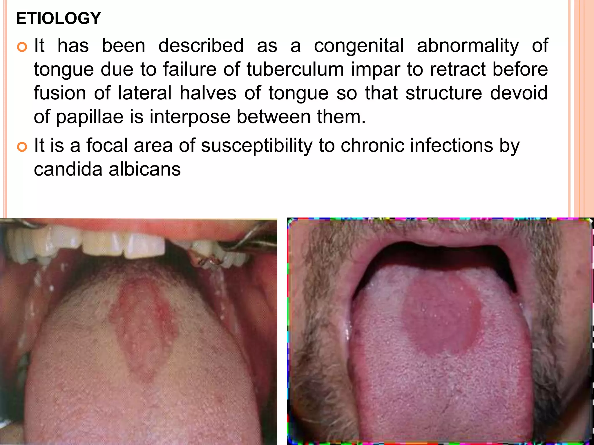 ETIOLOGY
 It has been described as a congenital abnormality of
tongue due to failure of tuberculum impar to retract before
fusion of lateral halves of tongue so that structure devoid
of papillae is interpose between them.
 It is a focal area of susceptibility to chronic infections by
candida albicans
 