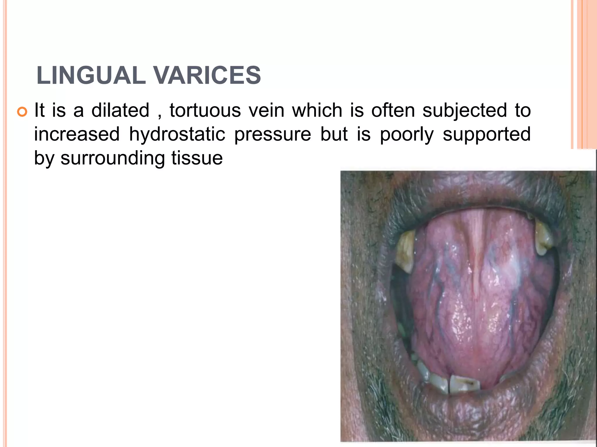 LINGUAL VARICES
 It is a dilated , tortuous vein which is often subjected to
increased hydrostatic pressure but is poorly supported
by surrounding tissue
 