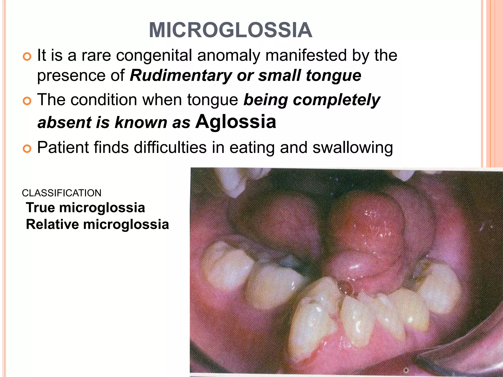 MICROGLOSSIA
 It is a rare congenital anomaly manifested by the
presence of Rudimentary or small tongue
 The condition when tongue being completely
absent is known as Aglossia
 Patient finds difficulties in eating and swallowing
CLASSIFICATION
True microglossia
Relative microglossia
 