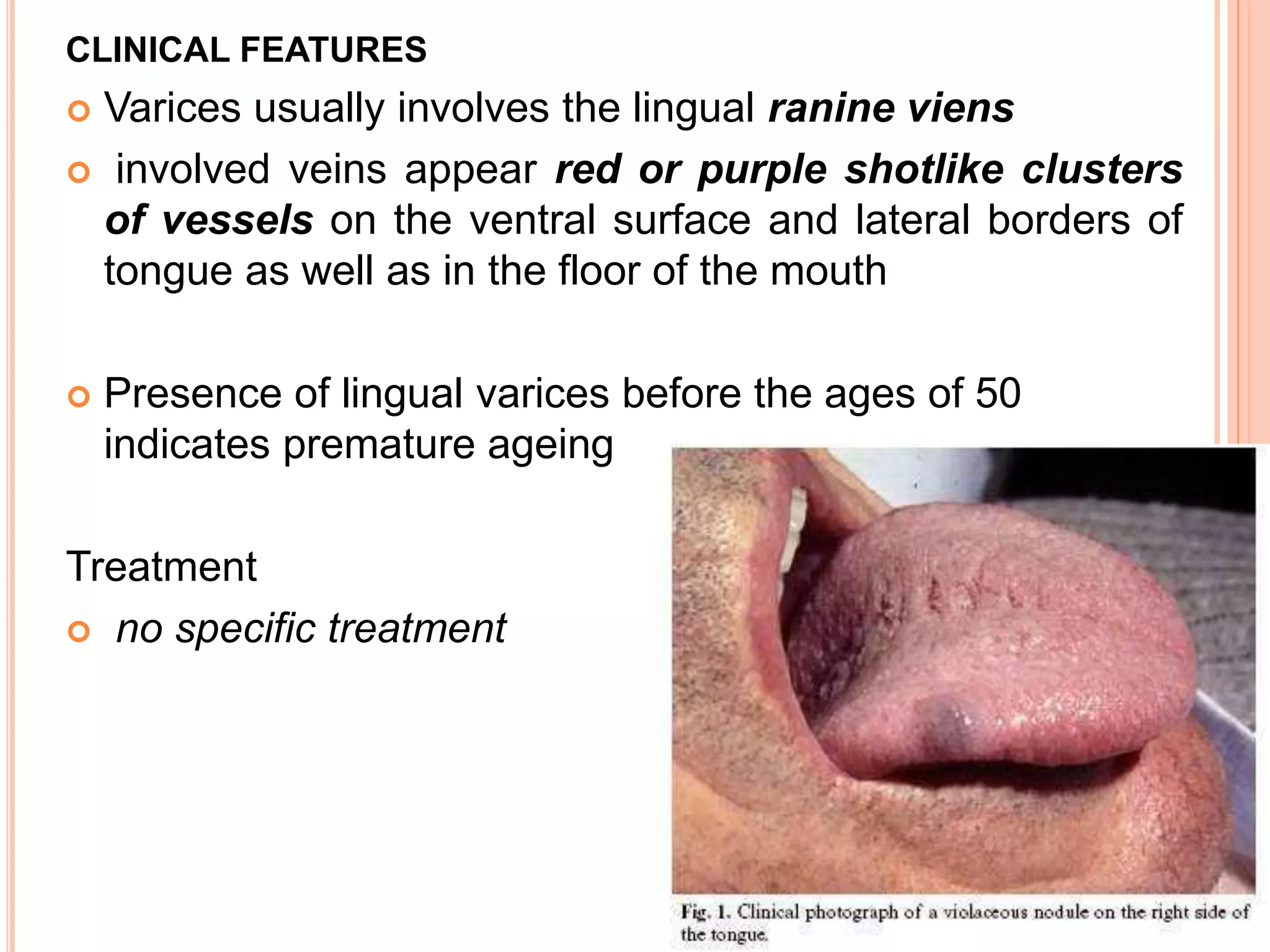 CLINICAL FEATURES
 Varices usually involves the lingual ranine viens
 involved veins appear red or purple shotlike clusters
of vessels on the ventral surface and lateral borders of
tongue as well as in the floor of the mouth
 Presence of lingual varices before the ages of 50
indicates premature ageing
Treatment
 no specific treatment
 