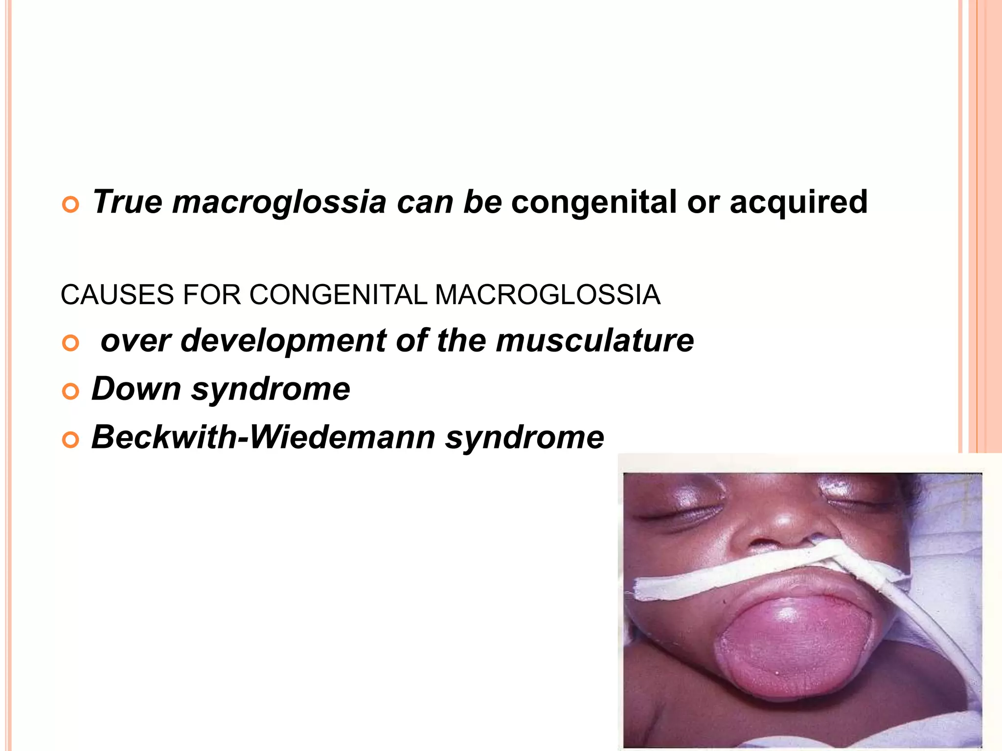  True macroglossia can be congenital or acquired
CAUSES FOR CONGENITAL MACROGLOSSIA
 over development of the musculature
 Down syndrome
 Beckwith-Wiedemann syndrome
 