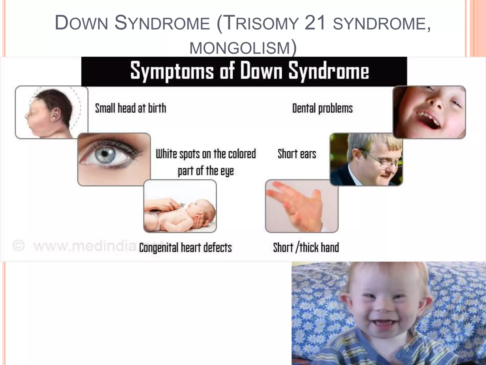 DOWN SYNDROME (TRISOMY 21 SYNDROME,
MONGOLISM)
 