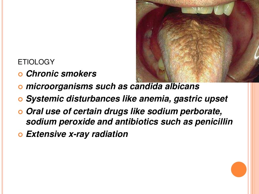 Developmental disturbances of tongue