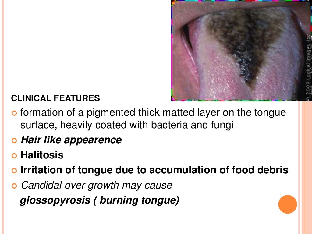 Developmental disturbances of tongue