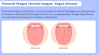 developmental disturbances of tongue.pptx