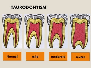 Bull Tooth Developmental disturbances of tooth morphology | PDF