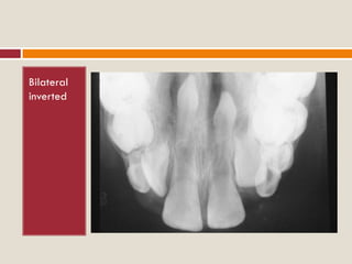 Developmental disturbances of tooth morpology | PDF
