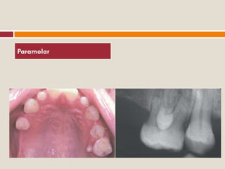 Paramolar Radiograph Developmental disturbances of tooth morpology | PDF