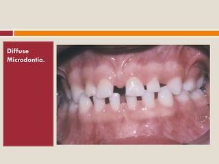 Micro Tooth Developmental disturbances of tooth morpology | PDF