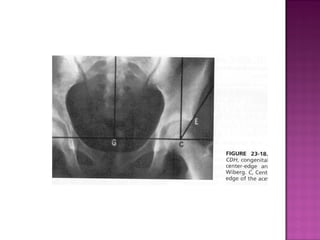  Indications include presence of reducible hip femoral head
directed toward triradiate cartilage on xray
 follow weekly ...