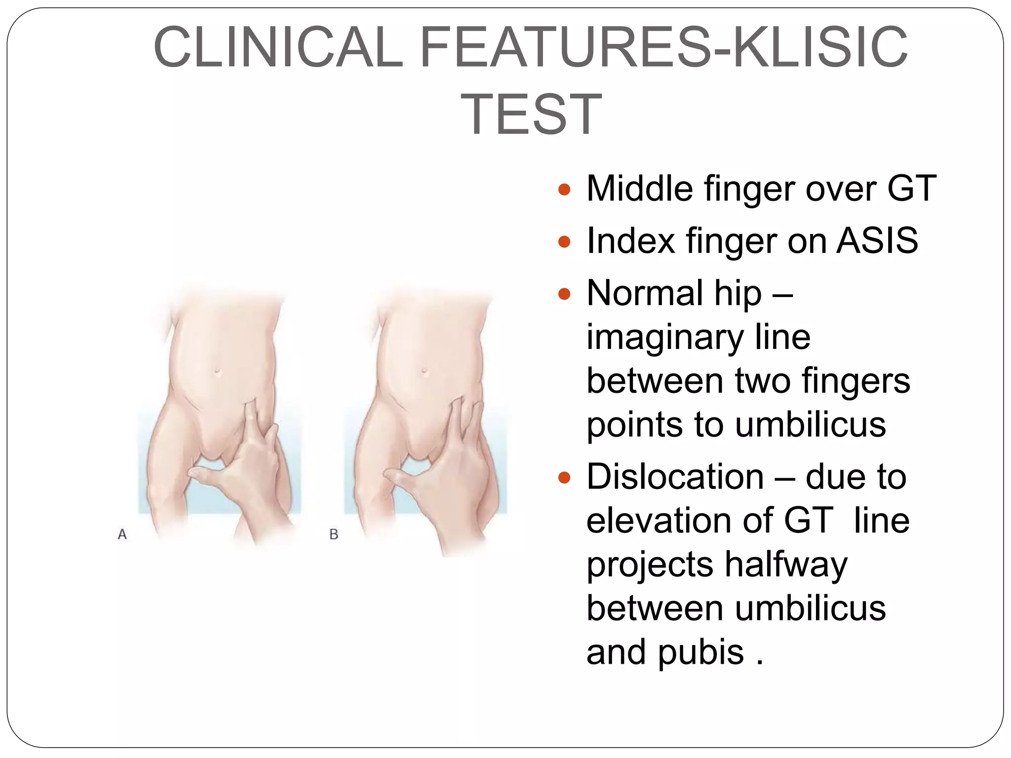 Developmental dysplasia hip | PPTX