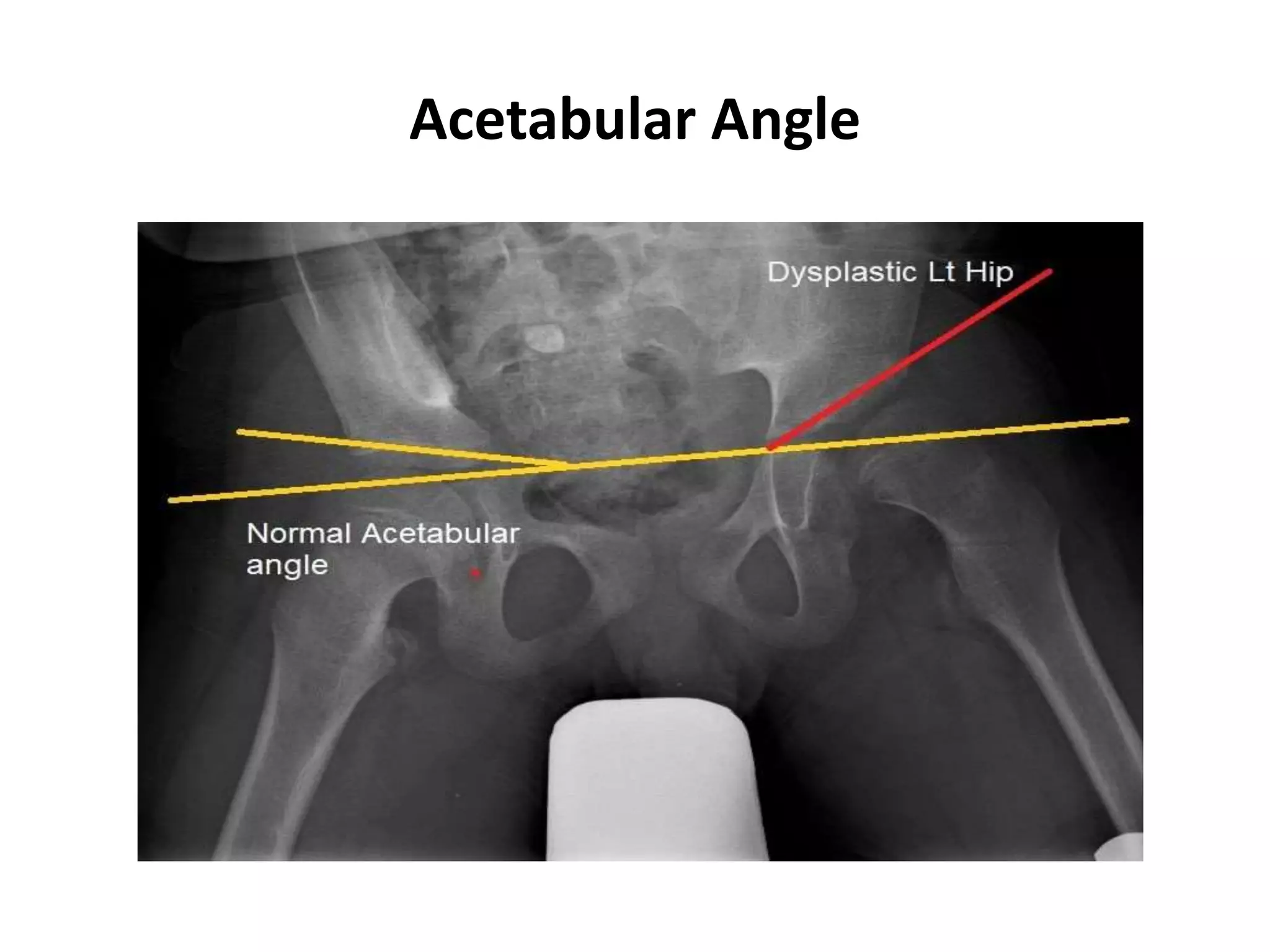 Developmental dysplasia hip | PPTX