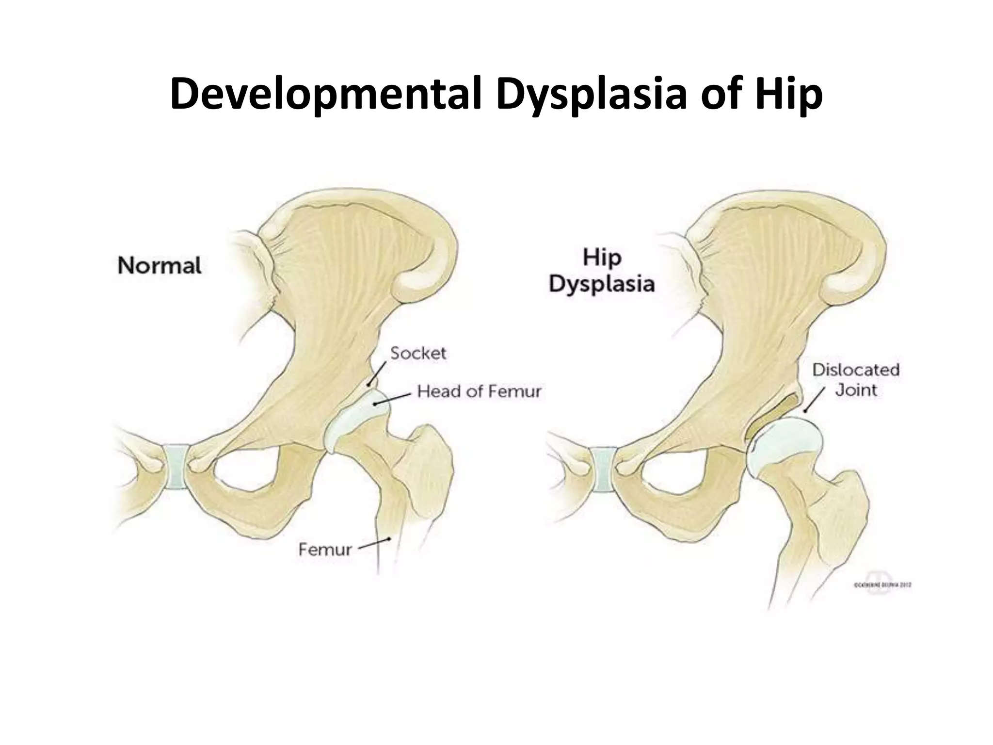 Developmental Dysplasia Hip PPTX