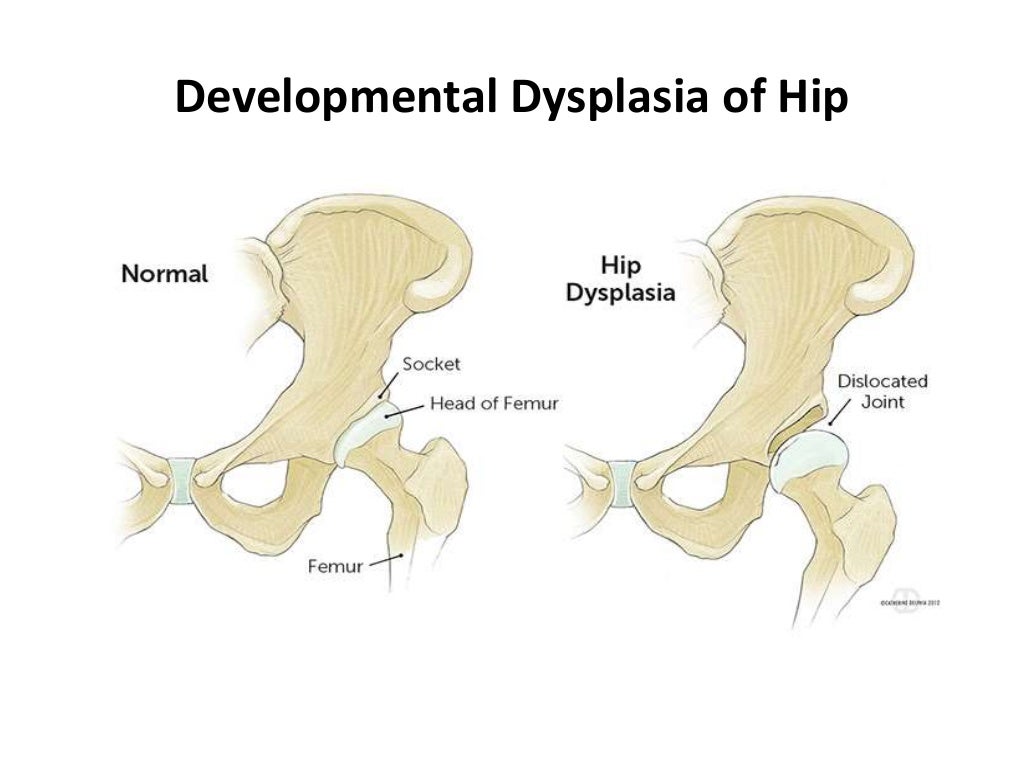Developmental dysplasia hip