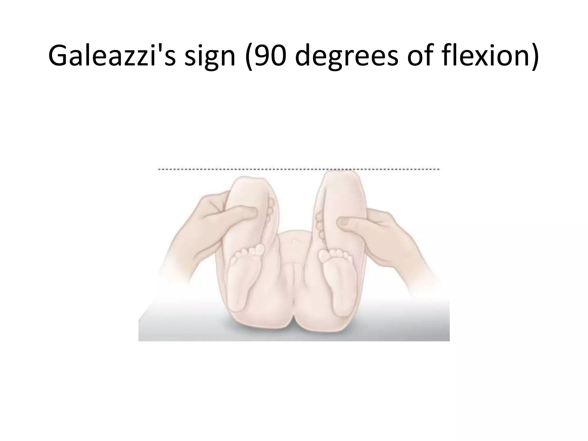 Developmental Dysplasia Of Hip PPTX developmental-dysplasia-of-hip-pptx