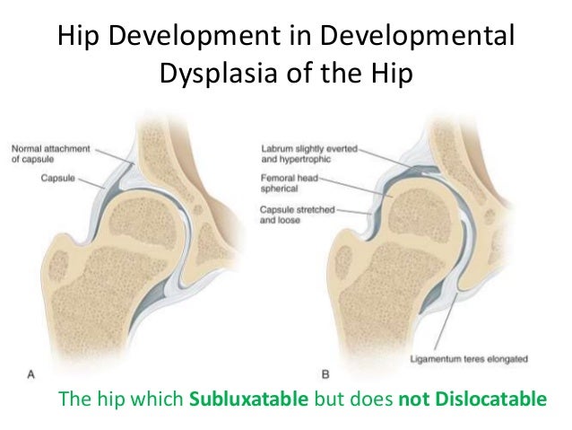 Image result for Developmental Dysplasia