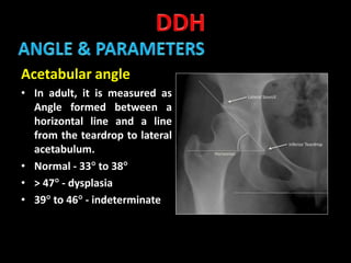 Developmental dysplasia of hip | PPTX