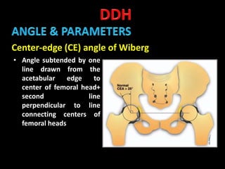 Developmental dysplasia of hip | PPTX