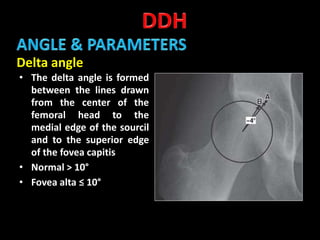 Developmental dysplasia of hip | PPTX