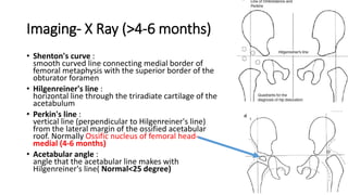 Developmental Dysplasia of Hip final.pptx