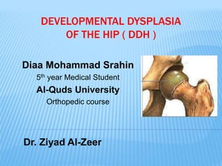 DEVELOPMENTAL DYSPLASIA
OF THE HIP ( DDH )
Diaa Mohammad Srahin
5th year Medical Student
Al-Quds University
Orthopedic course
Dr. Ziyad Al-Zeer
 