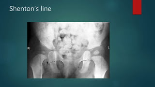 Developmental dysplasia of the hip | PPTX