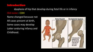 DEVELOPMENTAL DYSPLASIA OF THE HIP.pptx