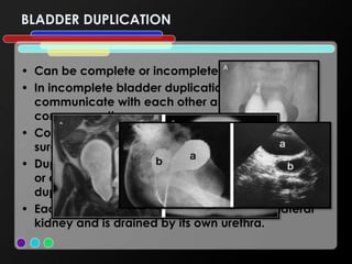 Development and congenital anomalies of urogenital system | PPTX