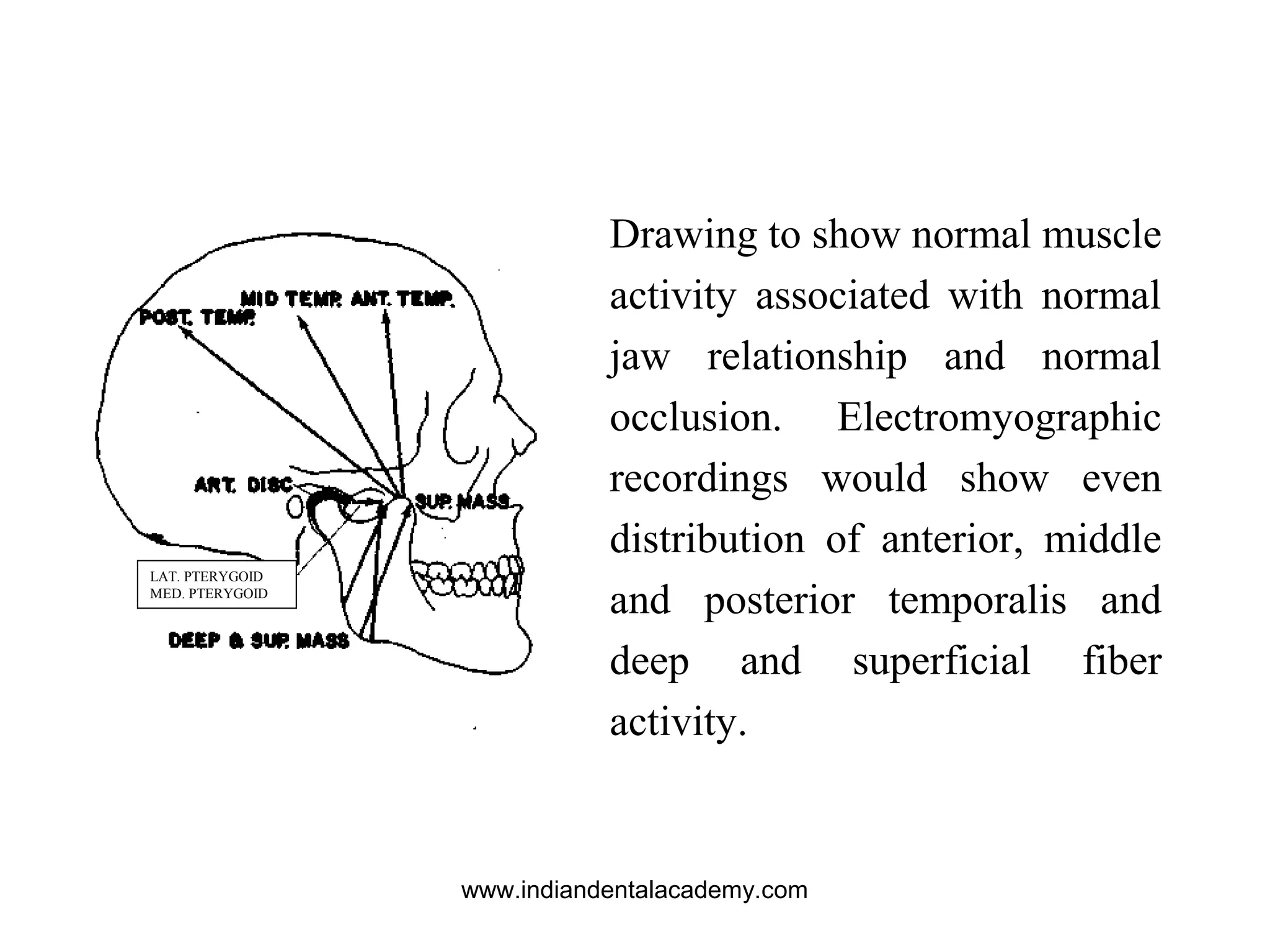 Drawing to show normal muscle
activity associated with normal
jaw relationship and normal
occlusion. Electromyographic
recordings would show even
distribution of anterior, middle
and posterior temporalis and
deep and superficial fiber
activity.
LAT. PTERYGOID
MED. PTERYGOID
www.indiandentalacademy.com
 